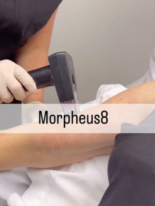 A patient's arm being examined. Morpheus8 is one of our most popular non-surgical skin tightening treatments