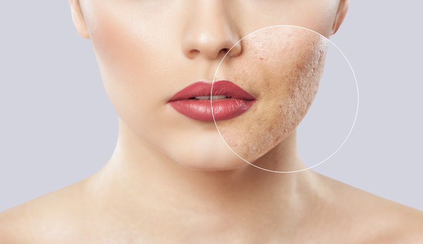 The Best Acne and Acne Scarring Treatments