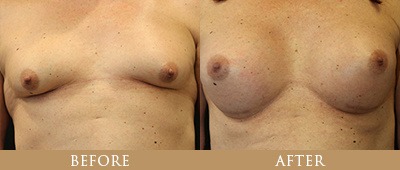 Dr. Gregory Chernoff Before and After