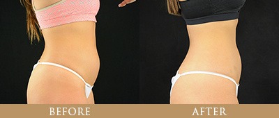 EON Fat Reduction