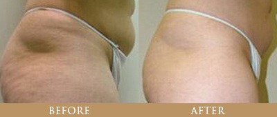 Fat Reduction