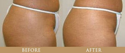 Fat Reduction