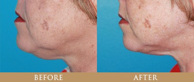 santa rosa facelift