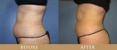 Ultrasound Therapy