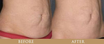 Fat Reduction