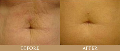 Fat Reduction