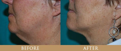 santa rosa facelift