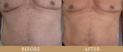 Fat Reduction