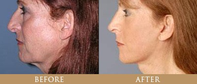 Dr. Gregory Chernoff Before and After