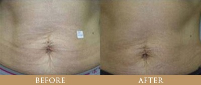 Fat Reduction