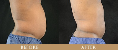 EON Fat Reduction