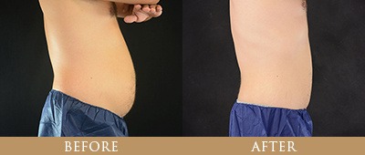 EON Fat Reduction