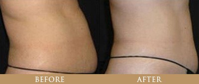 Fat Reduction
