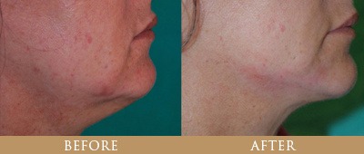 santa rosa facelift