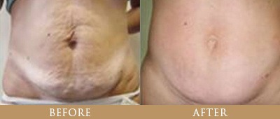 Fat Reduction