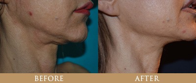 santa rosa facelift