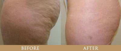 Fat Reduction