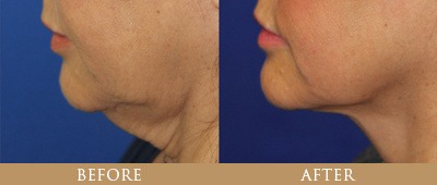 Dr. Gregory Chernoff Before and After