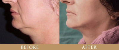 Dr. Gregory Chernoff Before and After