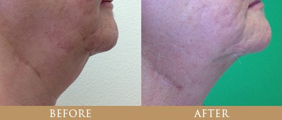 Dr. Gregory Chernoff Before and After