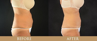 EON Fat Reduction