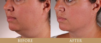 Dr. Gregory Chernoff Before and After