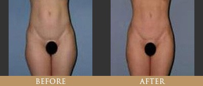 Ultrasound Therapy