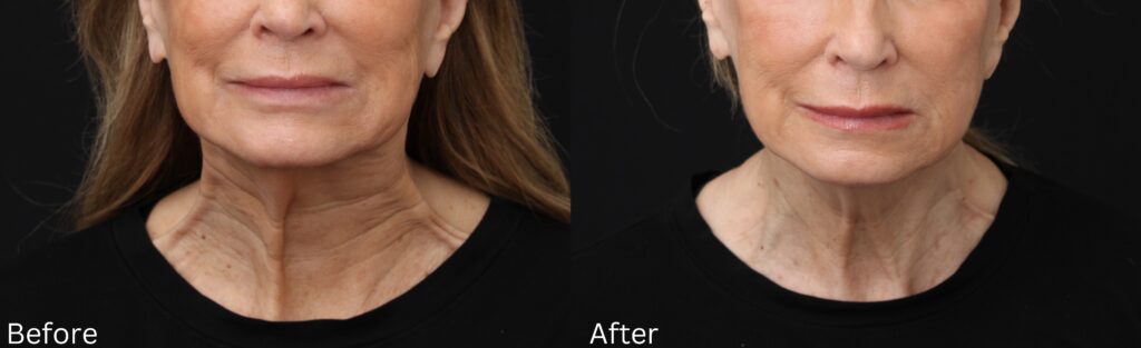 Botox