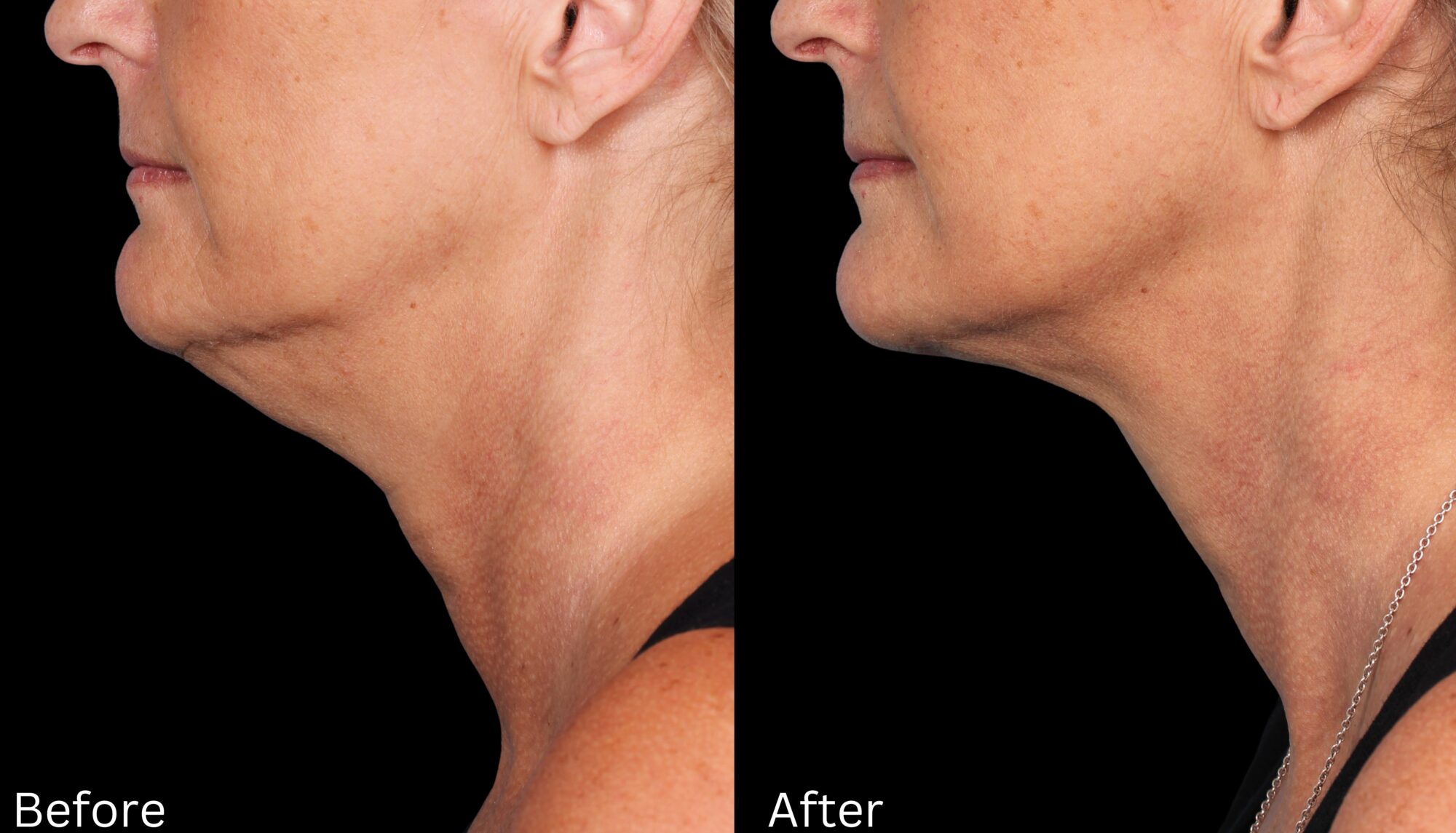 Kybella