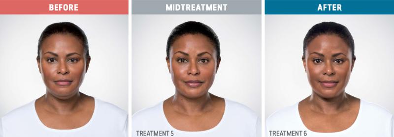 Kybella