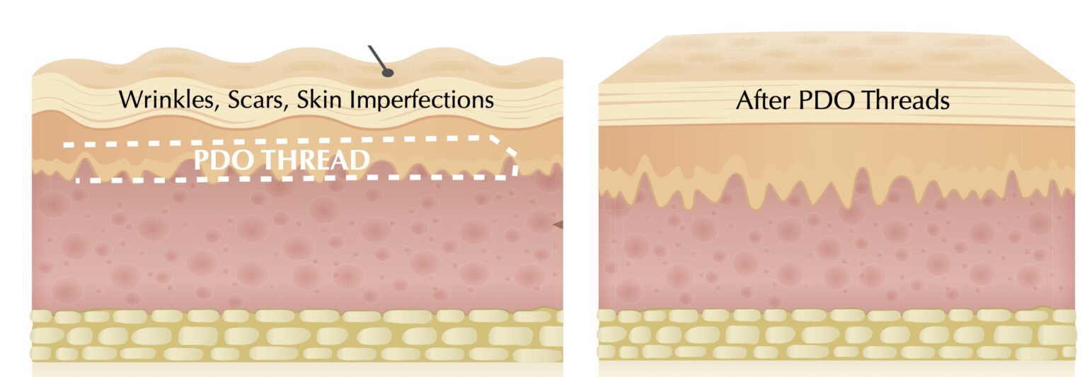 PDO_Threads_2-1-1536x533 cosmetic surgery santa rosa