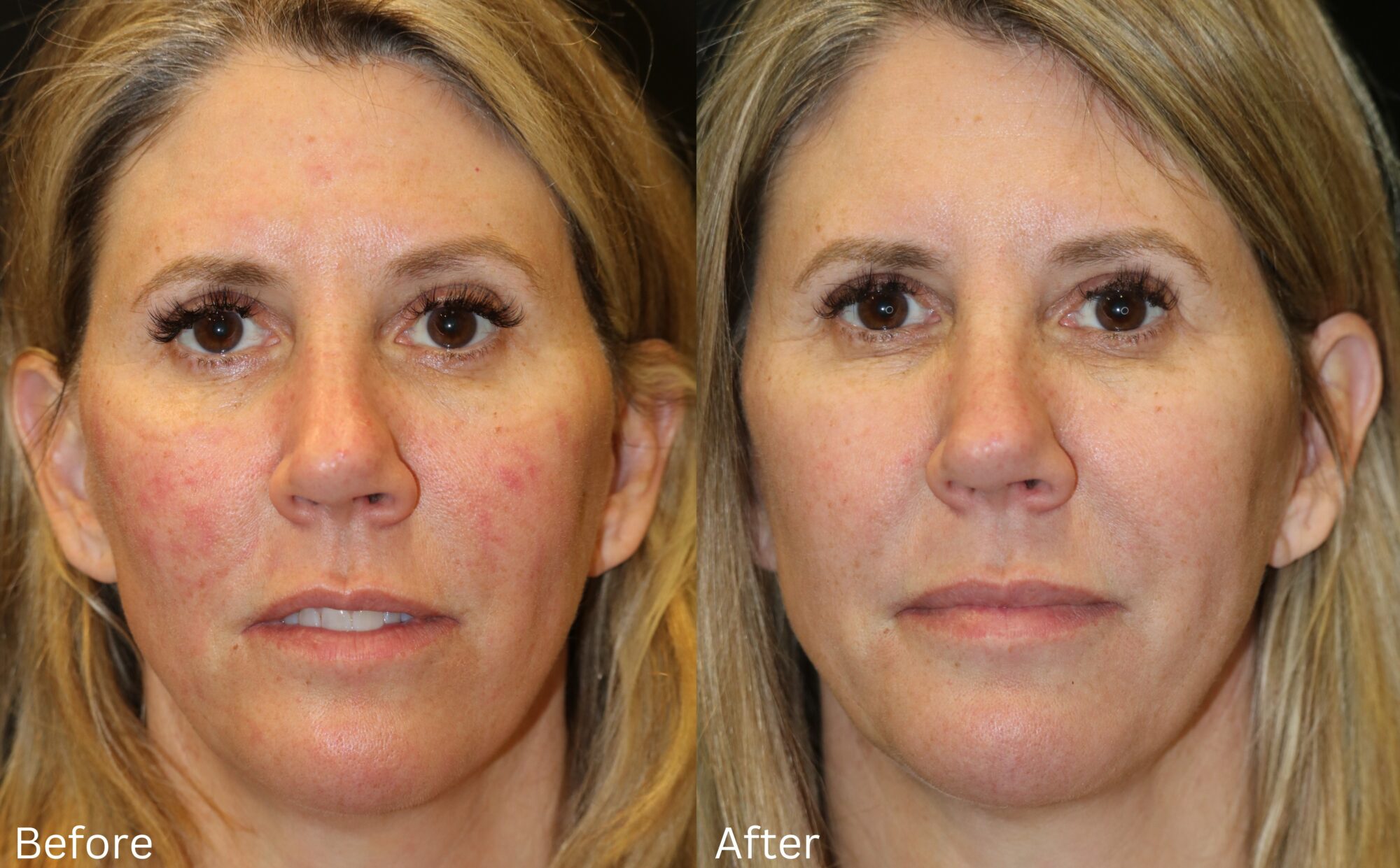 SaltFacial