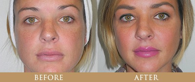 Cheek Implants