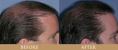 Hair Transplant