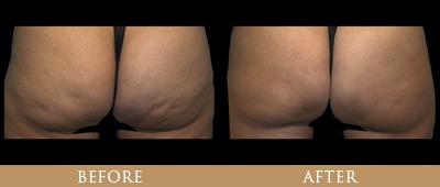 QWO Cellulite Reduction