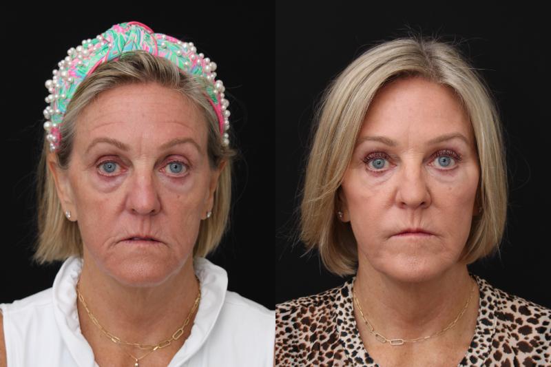 facelift santa rosa