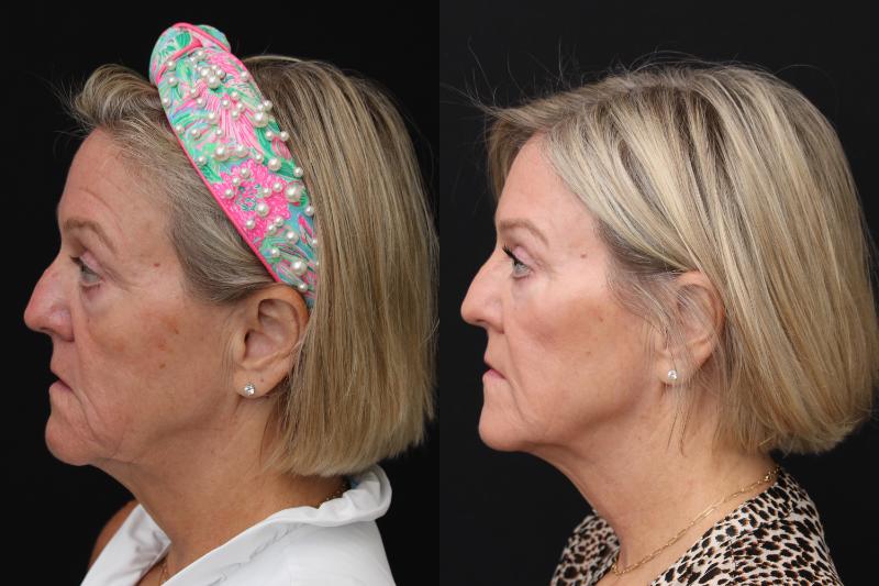 facelift santa rosa