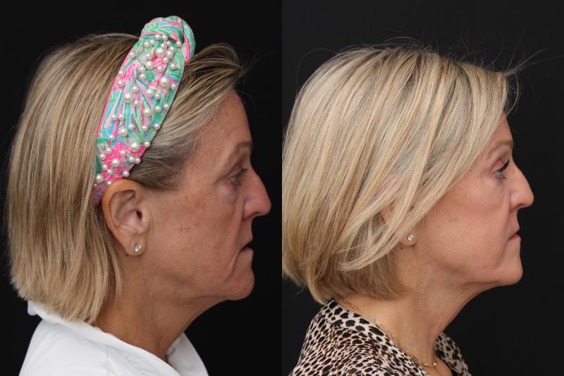 facelift santa rosa