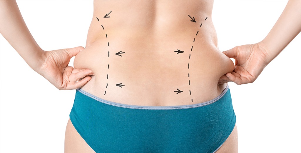 Example-Lipo Example-Lipo