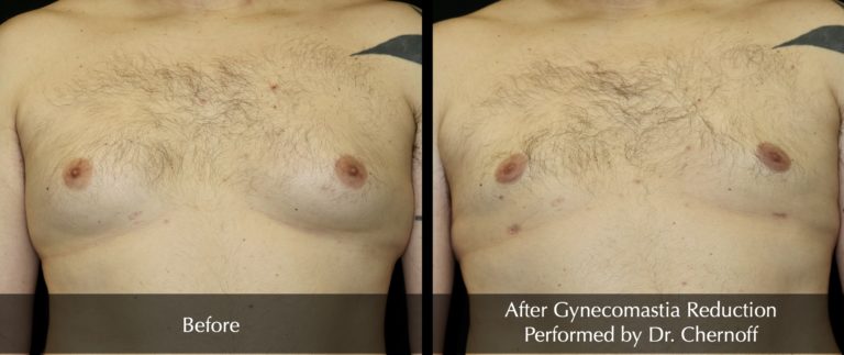 Gynecomastica_Reduction_1-768x323 Gynecomastica_Reduction_1-768x323