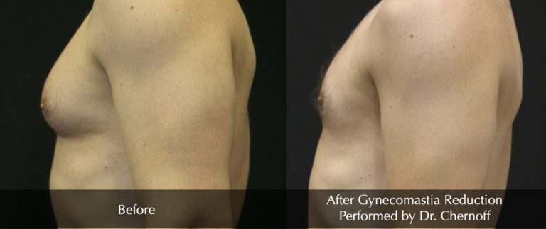 Gynecomastica_Reduction_3-768x323 Gynecomastica_Reduction_3-768x323