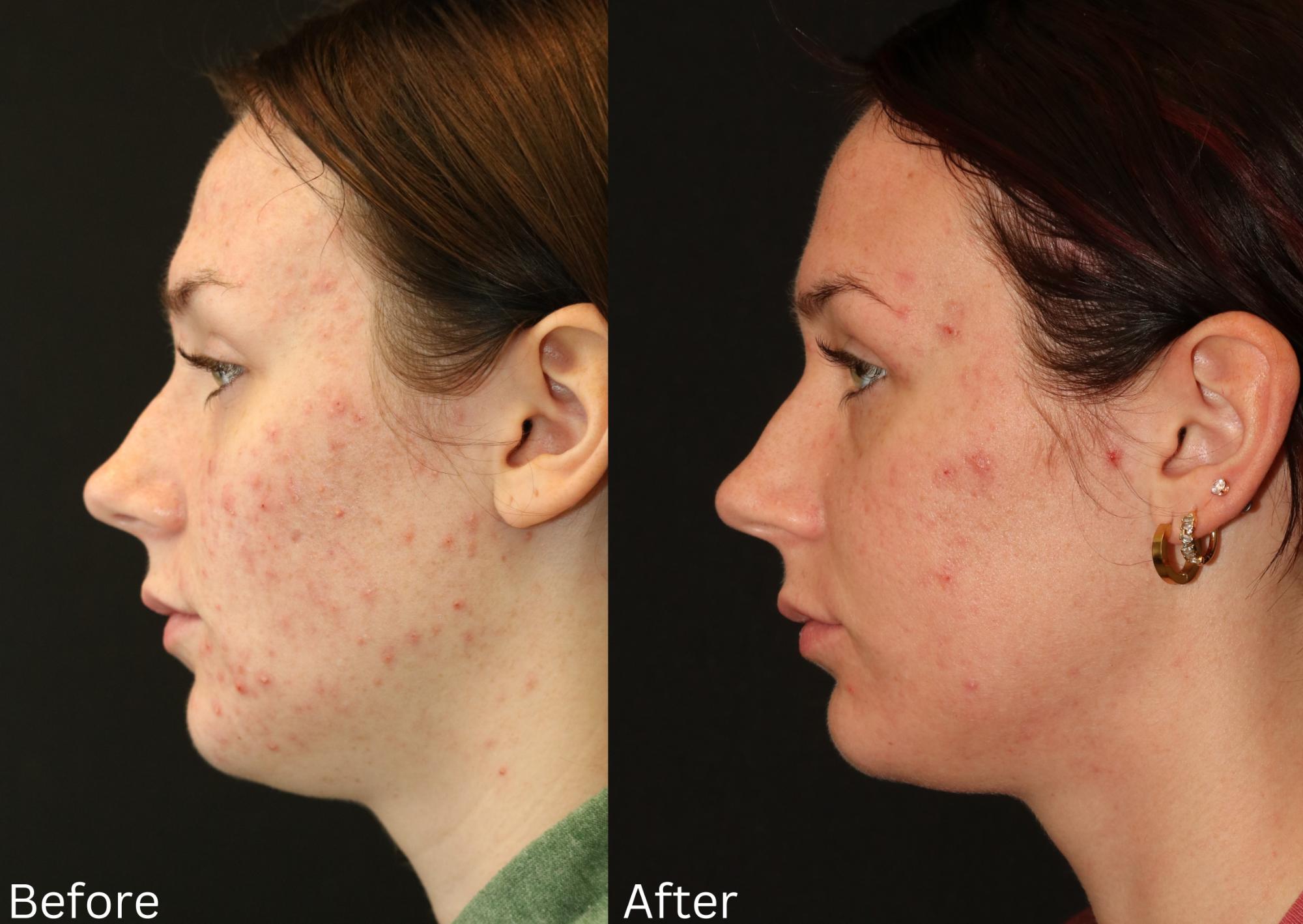 Acne Treatment