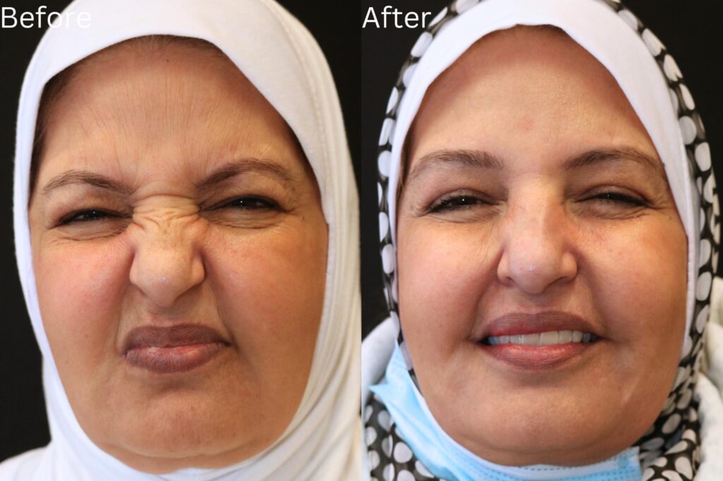 Botox
