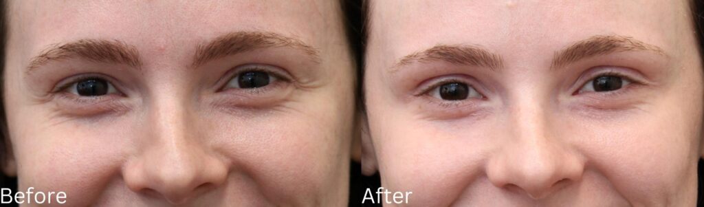 Botox