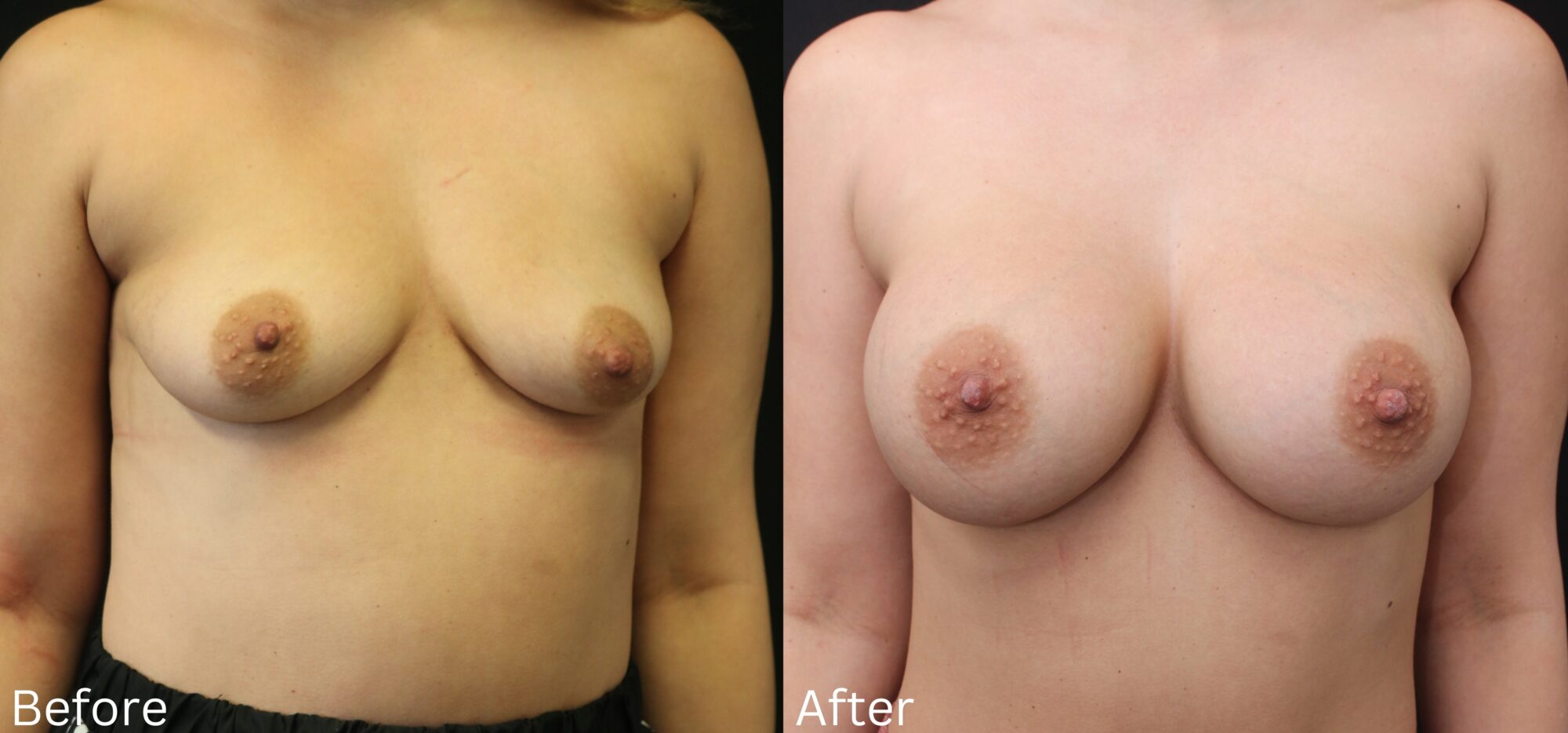 Breast Augmentation