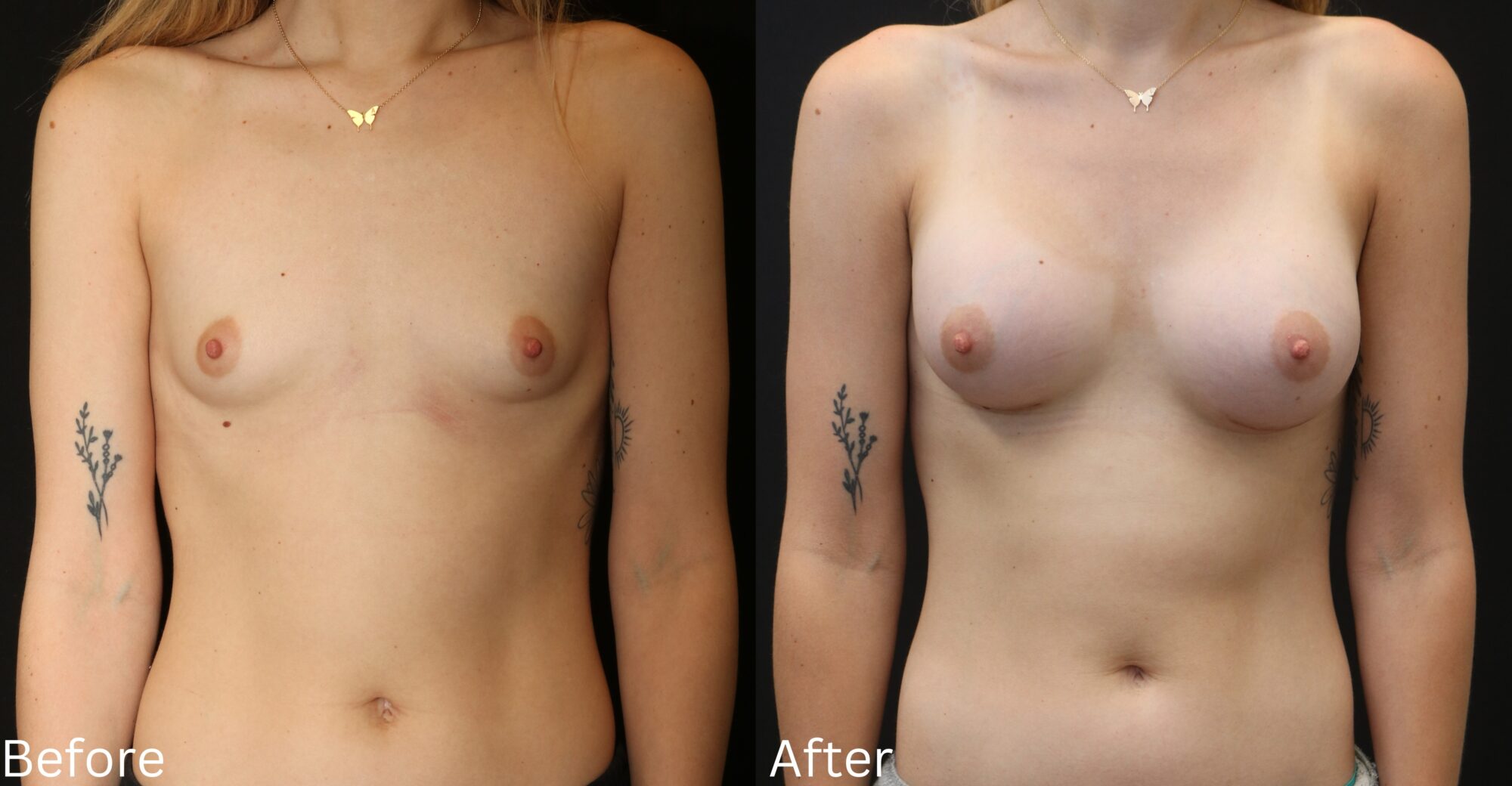 Breast Augmentation