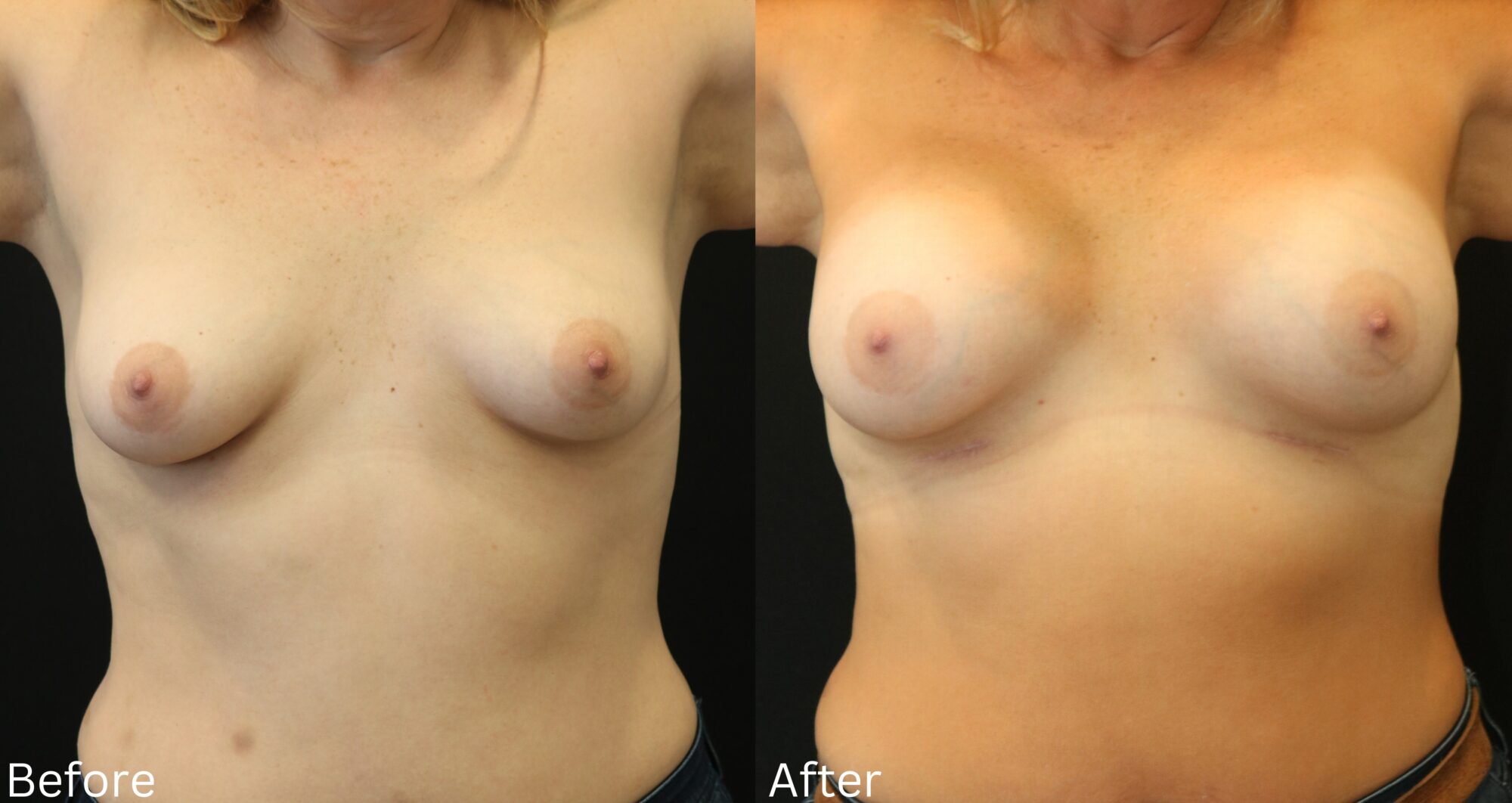 Breast Augmentation