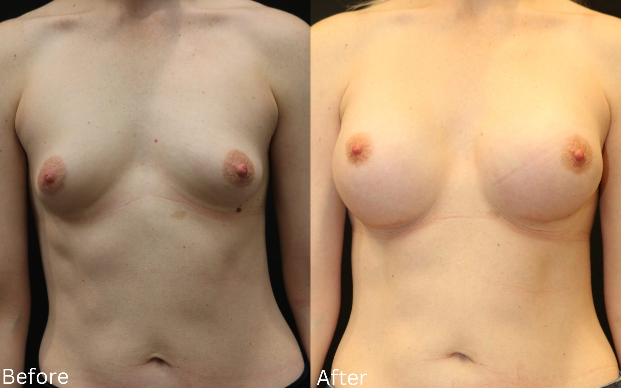Breast Augmentation