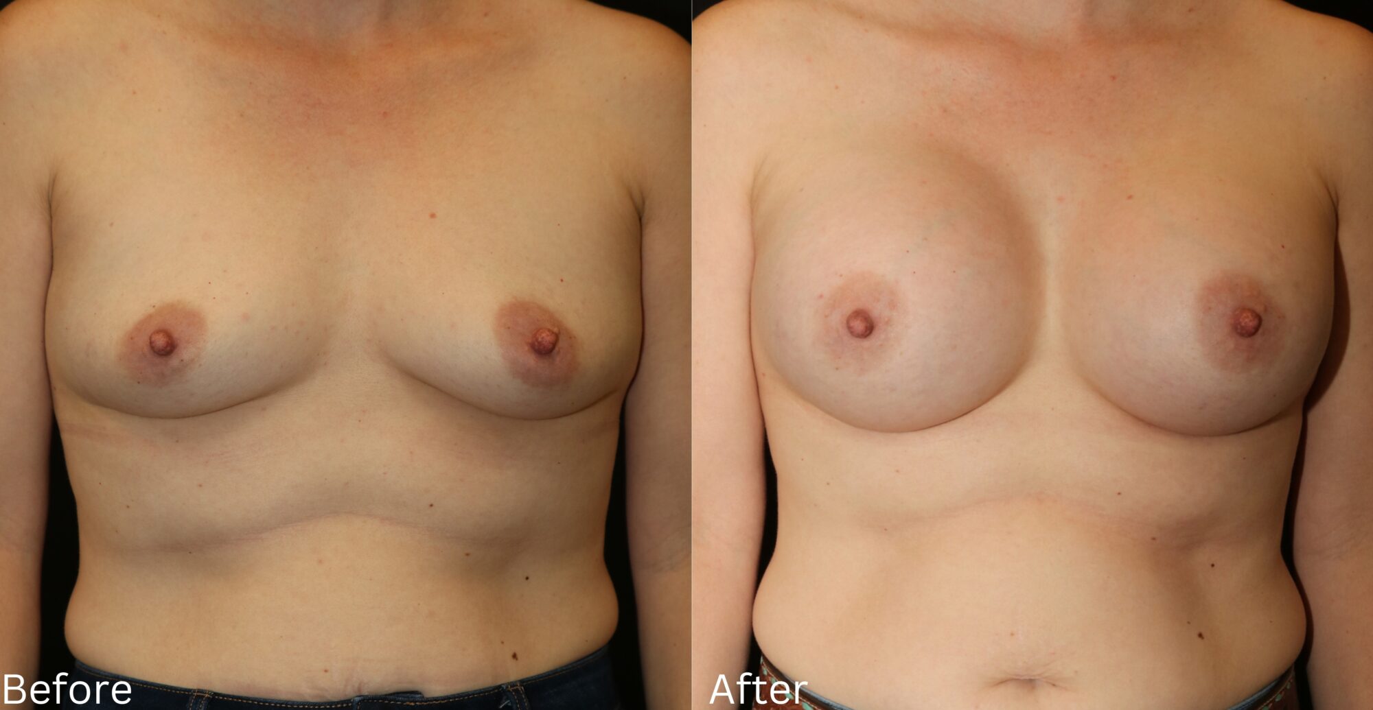 Breast Augmentation