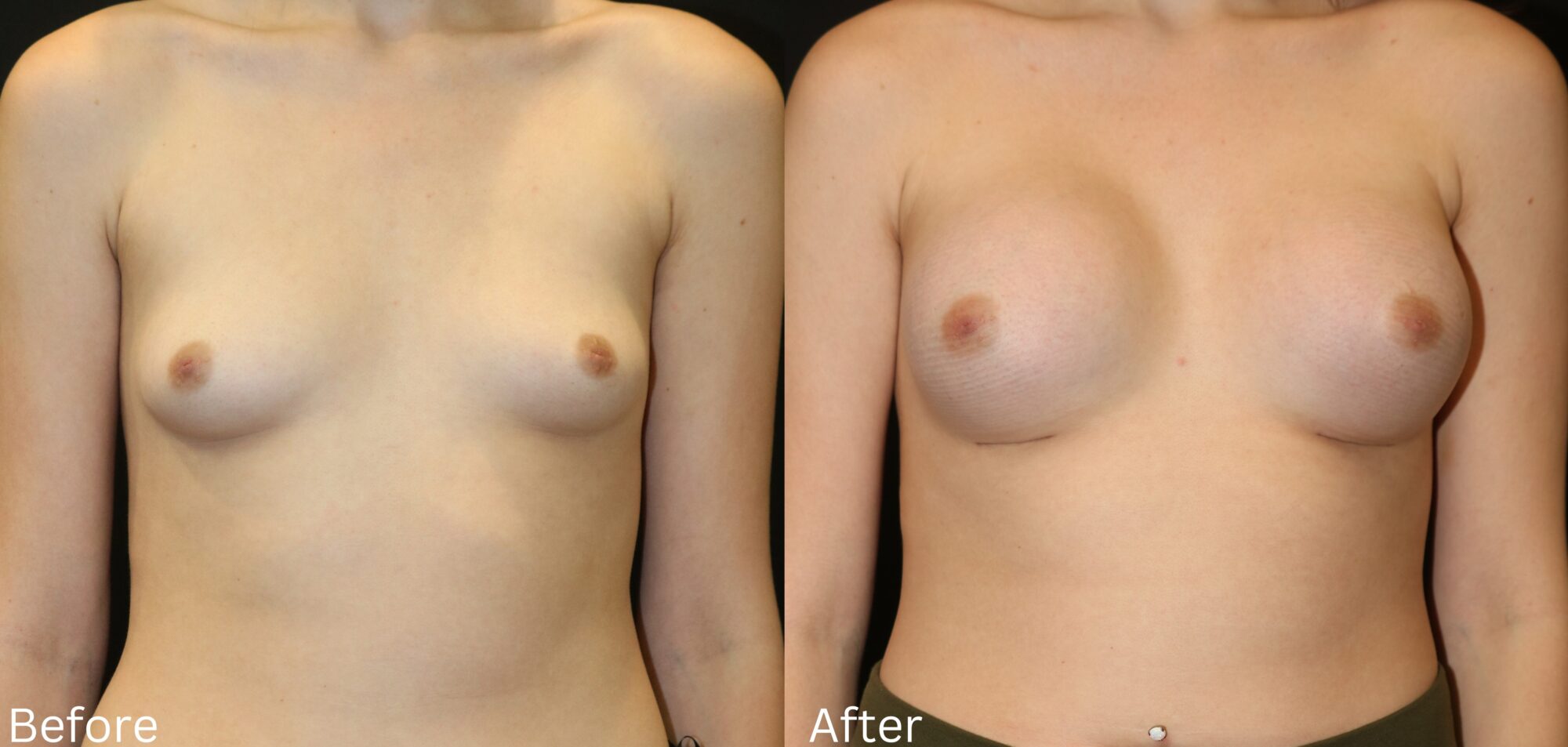 Breast Augmentation